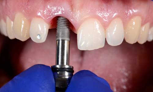 proteza fixa pe implanturi dentare