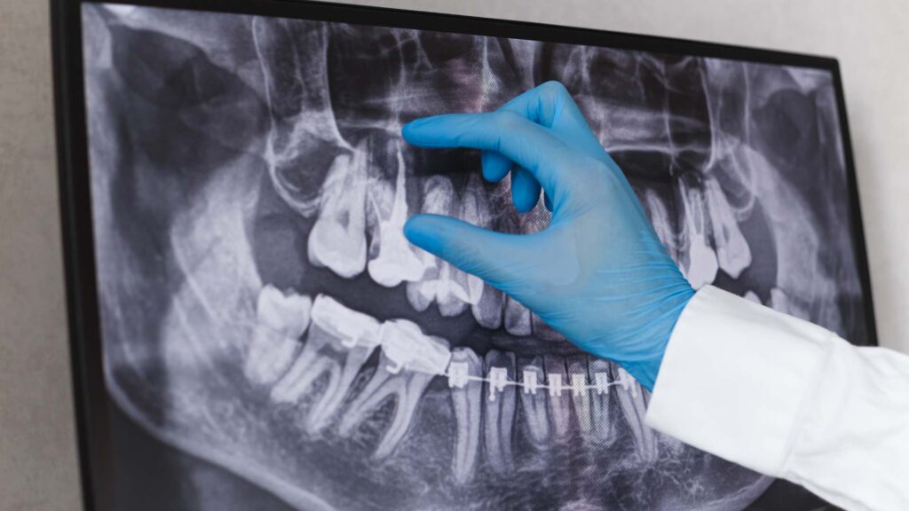 radiografie dentară