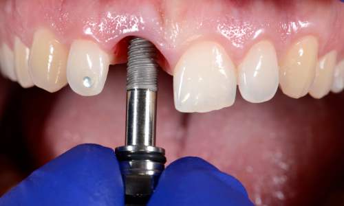 implant dentar straumann