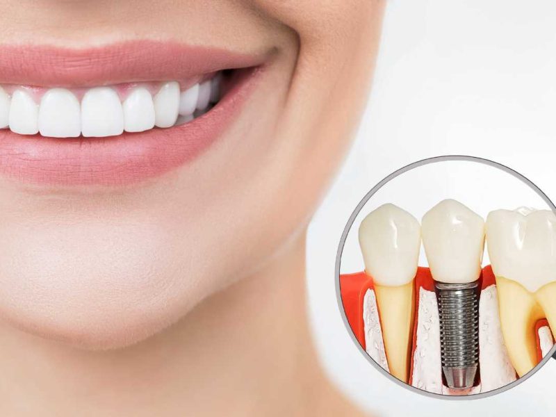 implantul dentar neodent