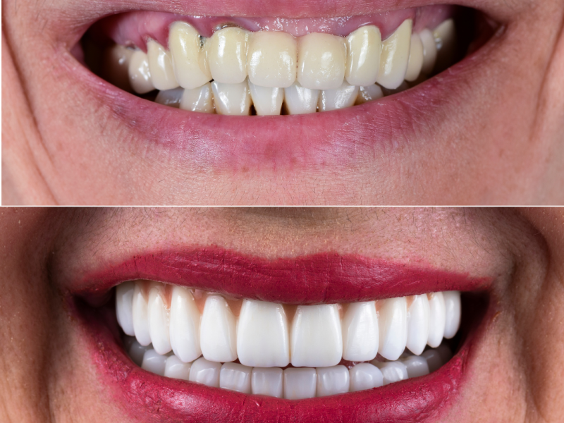 fatete dentare pret