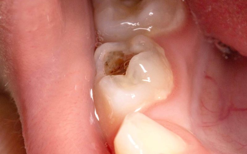 Carie-dentara-la-dintii-de-lapte.jpg Carie-dentara-la-dintii-de-lapte.jpg