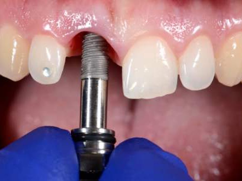 implant dentar straumann