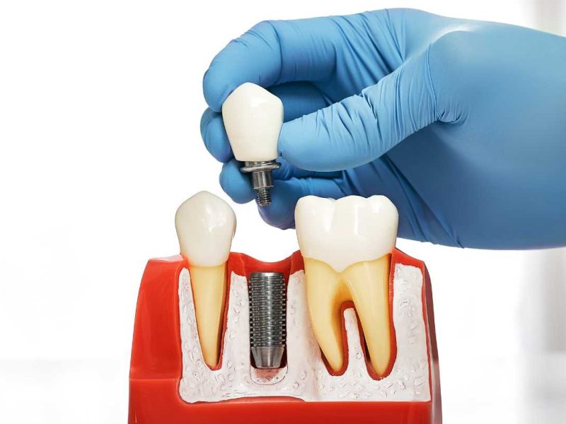 Implantul Dentar Neodent
