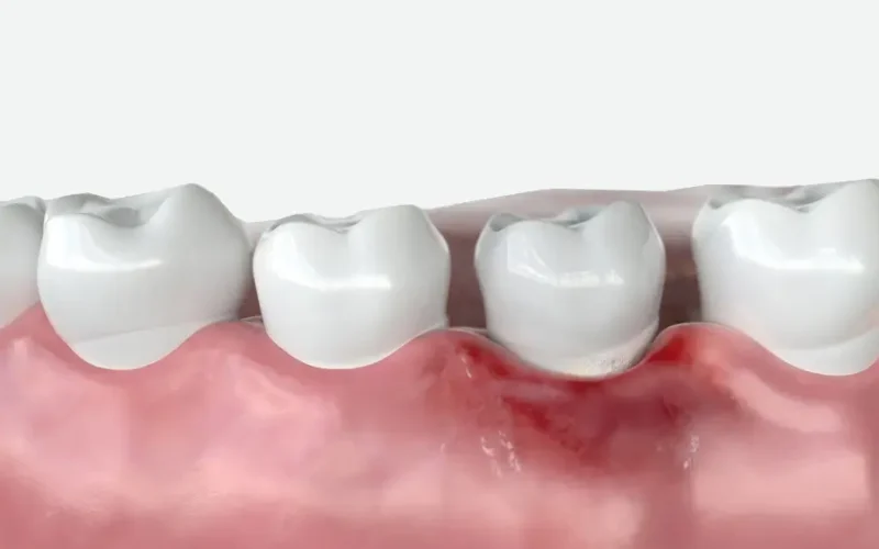 Mobilitate-dentară Mobilitate-dentară