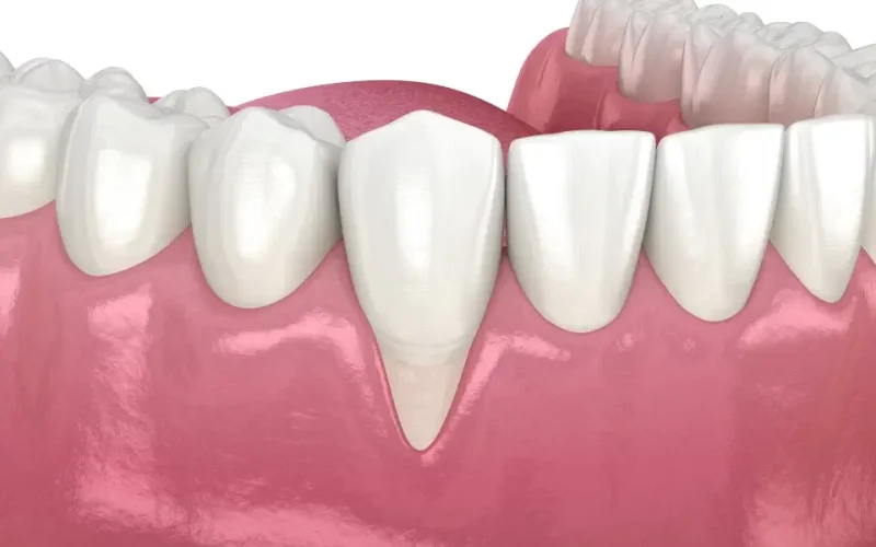 Retracții-gingivale-2 Retracții-gingivale-2