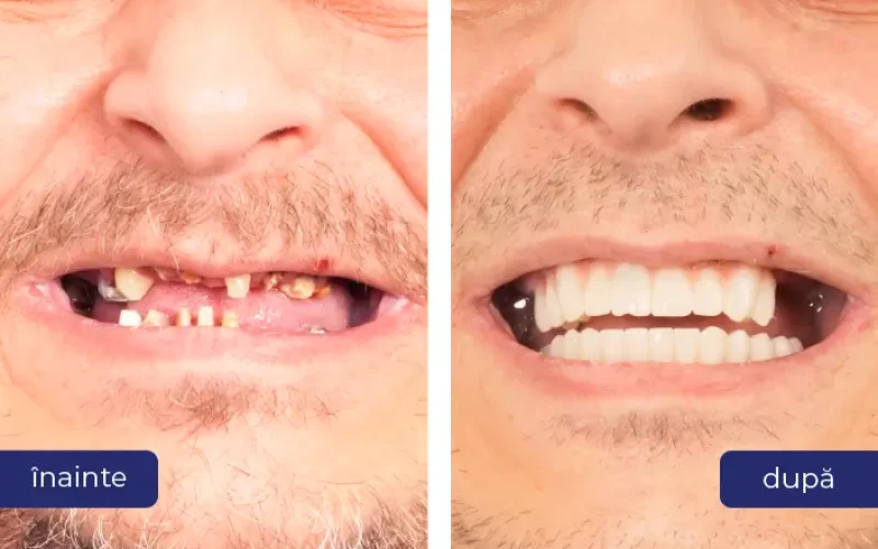 before after-01