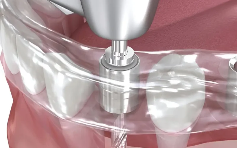 ghid-chirurgical-precizie-absoluta