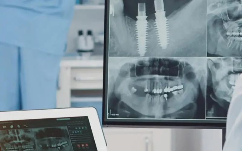implant-dentar-sector-1-clinica-stomatologica
